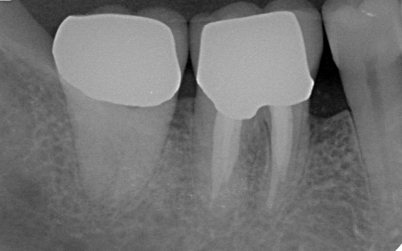 歯周病治療の症例