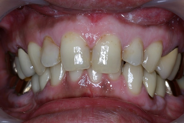 審美歯科症例