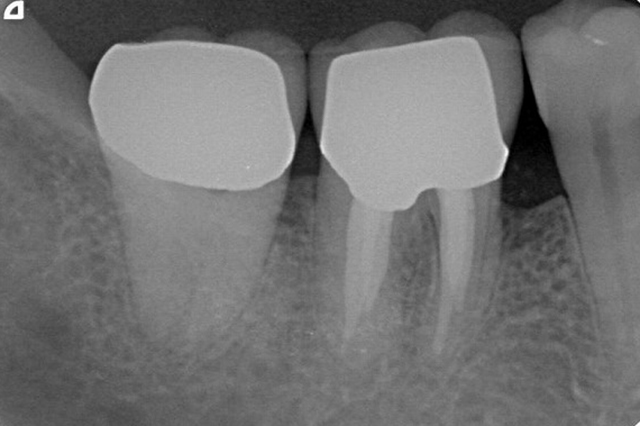 歯周病症例