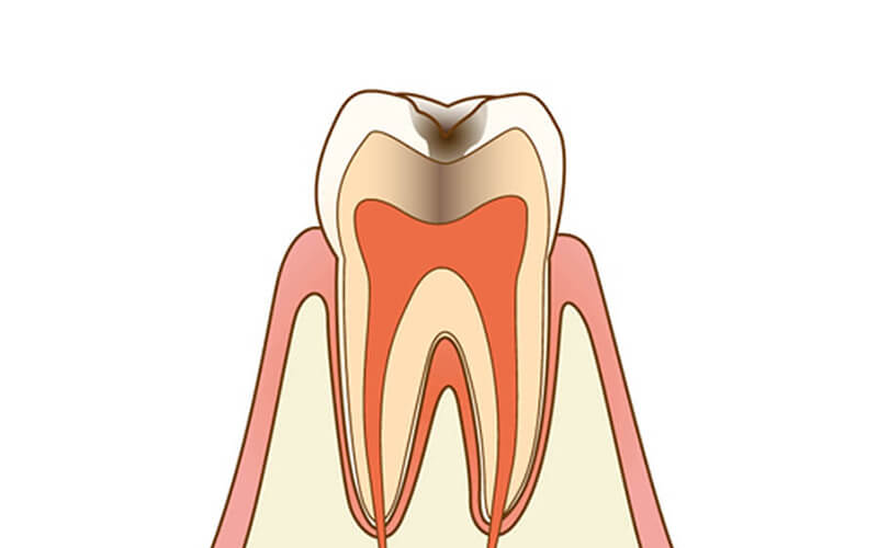虫歯c2