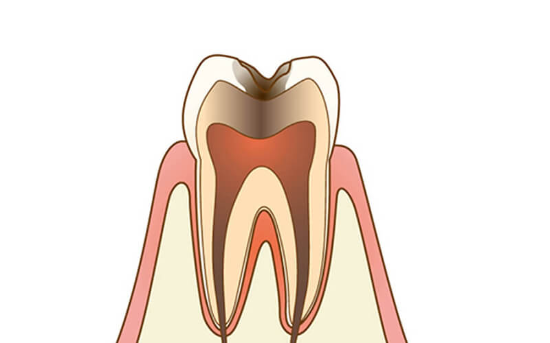 虫歯c3