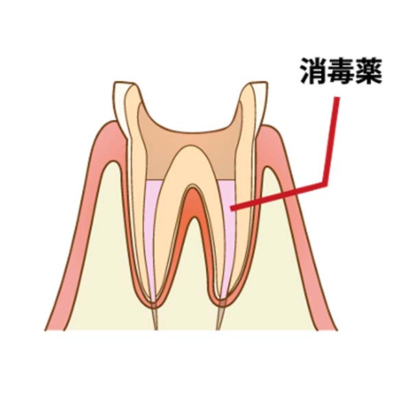 細菌が入らないように根管を緊密に封鎖します